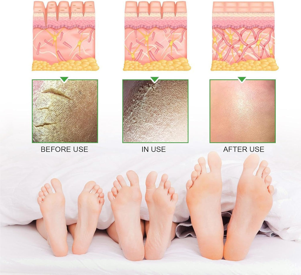 ساوث مون - كريم اليوريا 42% + حمض الساليسيليك 2% (الأصلي)